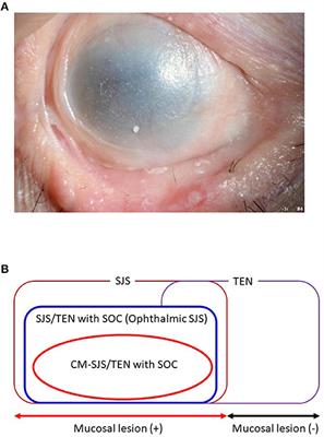 Findings by an International Collaboration on SJS/TEN With Severe Ocular Complications